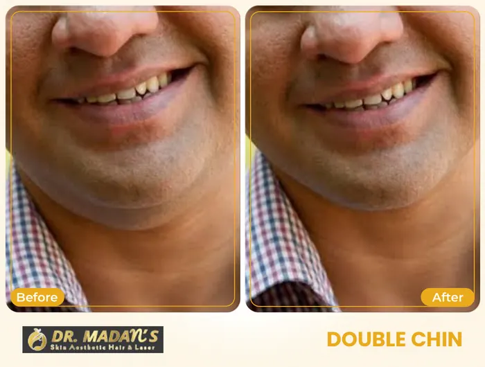 Double chin before and after result 2 at Dr Madan Aesthetics